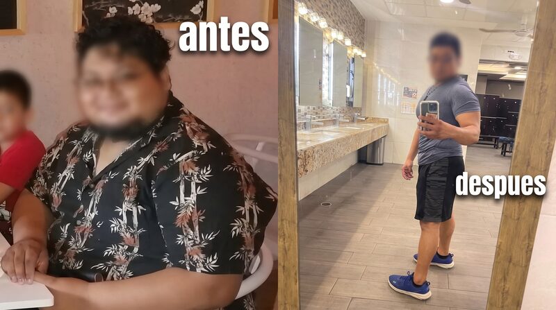 Resultado antes y después de cirugía bariátrica — Caso 1