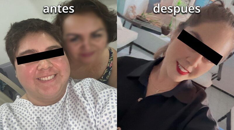 Resultado antes y después de cirugía bariátrica — Caso 2