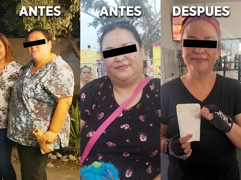 Resultado antes y después de cirugía bariátrica — Caso 3