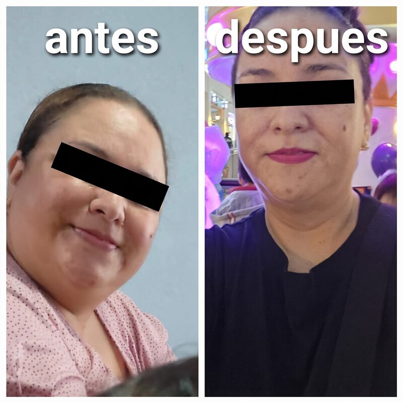 Resultado antes y después de cirugía bariátrica — Caso 4