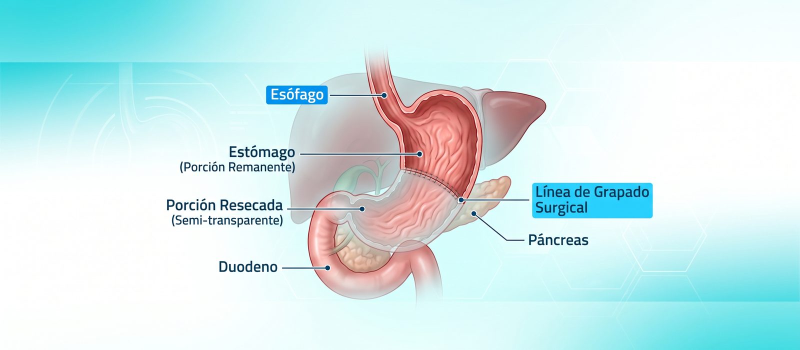 Gastric Sleeve